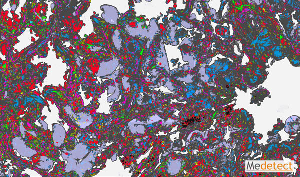 Alveolar epithelial metaplasia