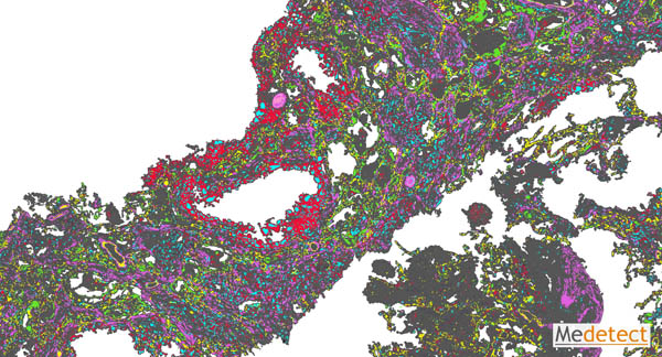 Structural and immunological alterations in fatal COVID-19