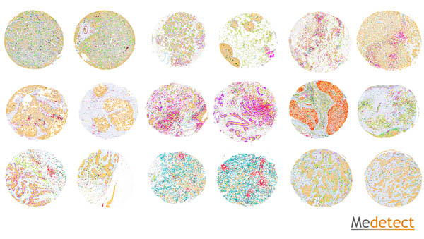 Breast cancer samples