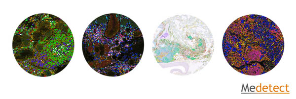 Multiplex immunohistochemistry in breast cancer