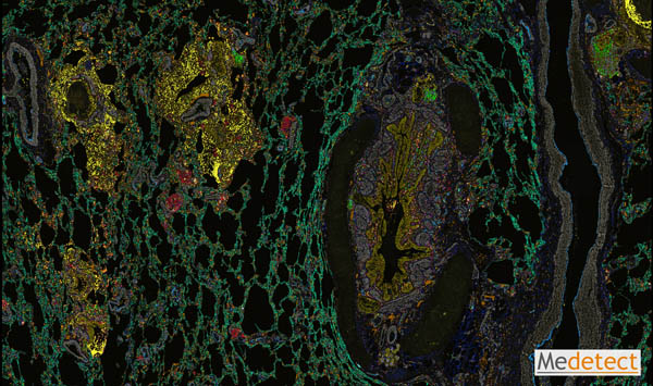 Remodelled small airway (bronchiole) and alveolar immune cell infiltrates in COPD lung tissue