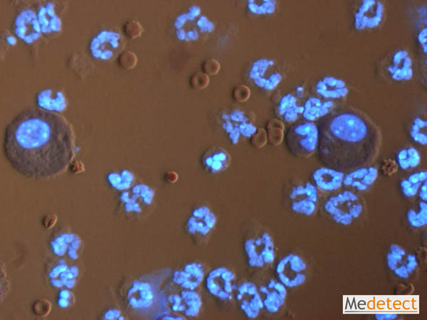Bronchoalveolar lavage sample
