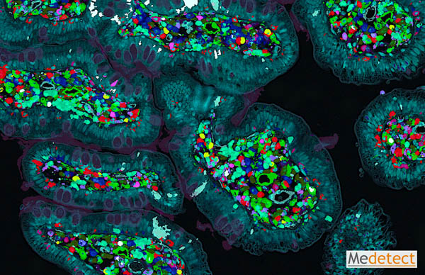 Mixed cell populations in intenstines affected by Crohn's Disease
