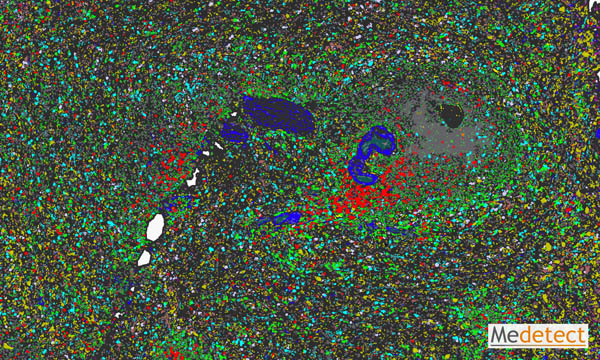 Spleen tissue from severe COVID-19